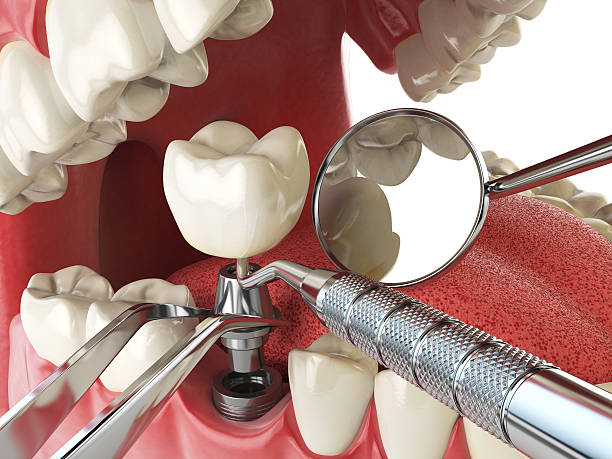 Best Emergency Wisdom Teeth Removal in Woodsboro, TX